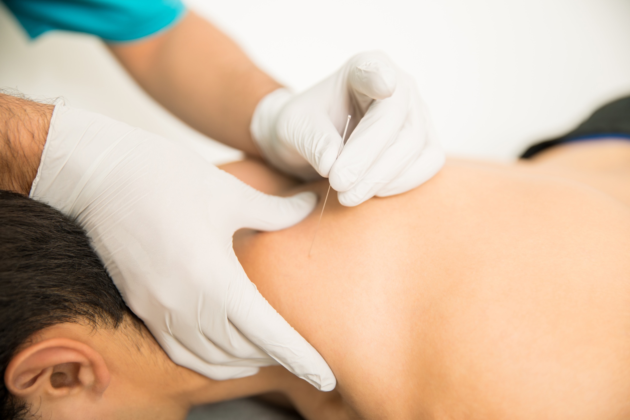 Nahaufnahme eines hemdlosen mannes der eine trockennadeltherapie von einem arzt in der klinik erhaelt
